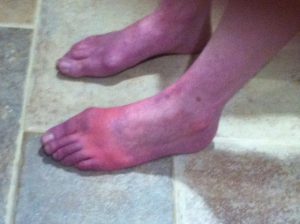 RSDSA CRPS Awareness #TPBF #CRPS